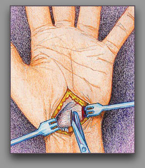 Carpal Tunnel Surgery - Ouch that stings!